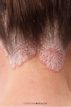 Lab tests for Lupus diagnosis