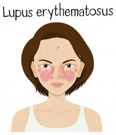 Parotid gland swelling