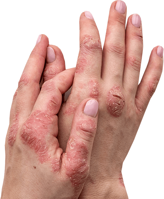 Psoriatic skin plaques